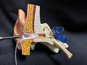 Closed tweezers for placing an otoblock on the EAR/BeBird Note5 otoscope on an ear model.