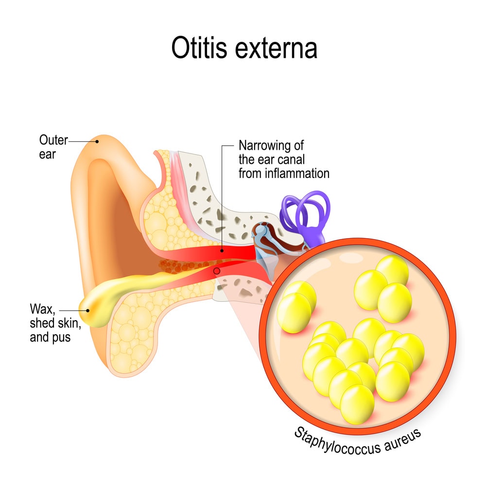 Swimmer's ear. Otitis externa is inflammation of the ear canal. bacteria that cause this disease. Close up of Staphylococcus aureus. Human anatomy. Vector illustration for medical use. Earinc.com, Boulder Colorado